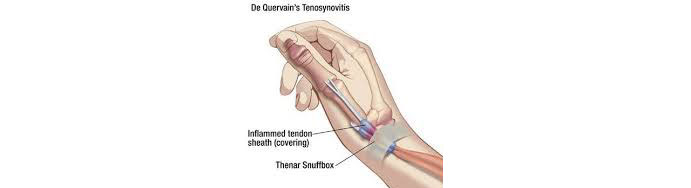 De-QuervainTenosynovitis