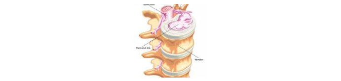 Herniated-Disc