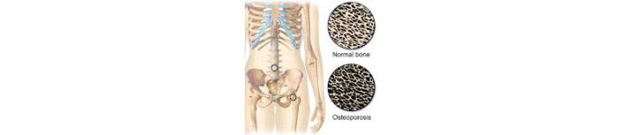 Osteoporosis