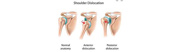 Shoulder-Dislocation