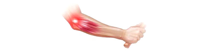 Tennis-Elbow