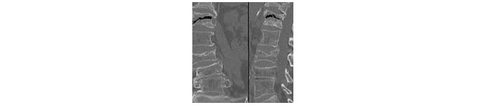 Vertebral-Fracture